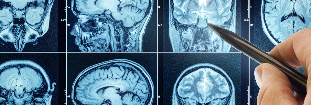 Brain Structure Differences Associated with Early Adolescent Substance Use