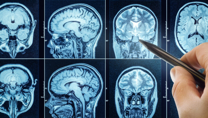 Brain Structure Differences Associated with Early Adolescent Substance Use
